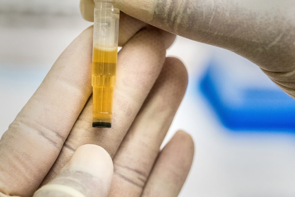 close up of a urine sample held with latex medical gloves